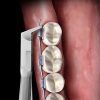 PINCE COUPE DISTAL SLIM