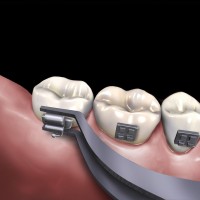 PINCE ORAL ULTRADELGADA